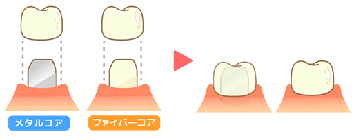 メタルコアとファイバーコアの画像