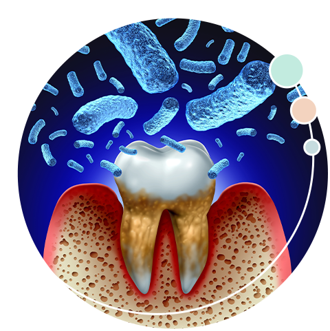 歯ぐきや歯の周りに炎症を引き起こす歯周病。